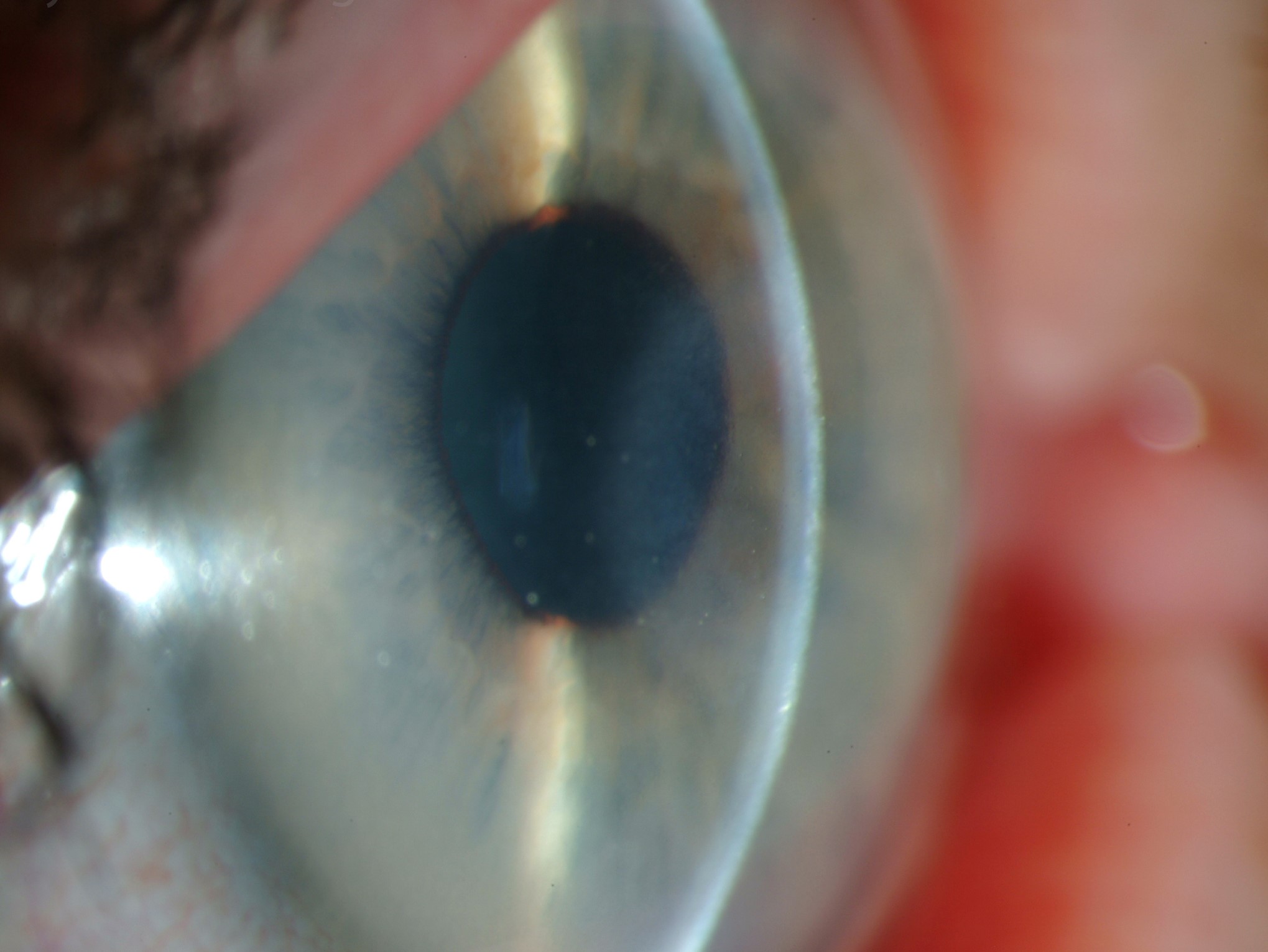 Schnyder Corneal Dystrophy Clinical Photograph 2 Schnyder Corneal Dystrophy: slit-lamp photograph, second view