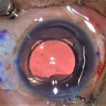 Scleral Fixated Intraocular Lens: clinical photograph