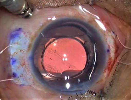 Scleral-Fixated IOL: Anchoring a Lens Without Capsular Support