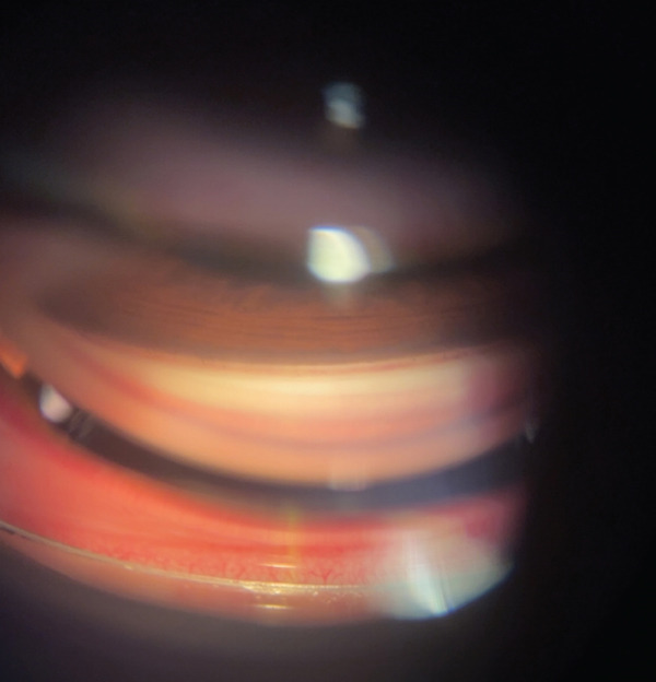 Selective Laser Trabeculoplasty: A First-Line Treatment Now, Not Just a Backup