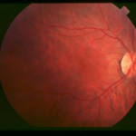 Clinical eye photograph illustrating Senior Loken Syndrome Nephronophthisis Retinitis