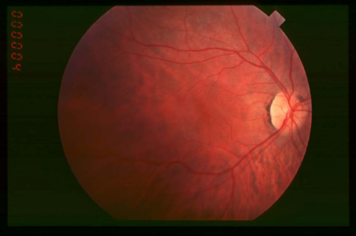Senior-Loken Syndrome: When Retinitis and Kidney Failure Share One Cause