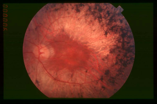 Clinical eye photograph illustrating Senior Loken Syndrome Nephronophthisis Retinitis