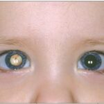 Sensory Strabismus: clinical photograph