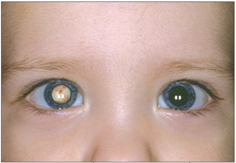 Sensory Strabismus: When Poor Vision Causes the Misalignment
