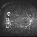 Sickle Cell Retinopathy: clinical photograph