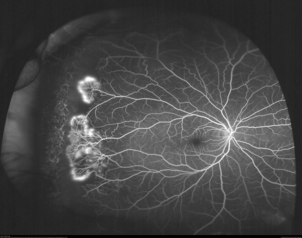Sickle Cell Retinopathy: Staging, Screening and Surgical Precautions
