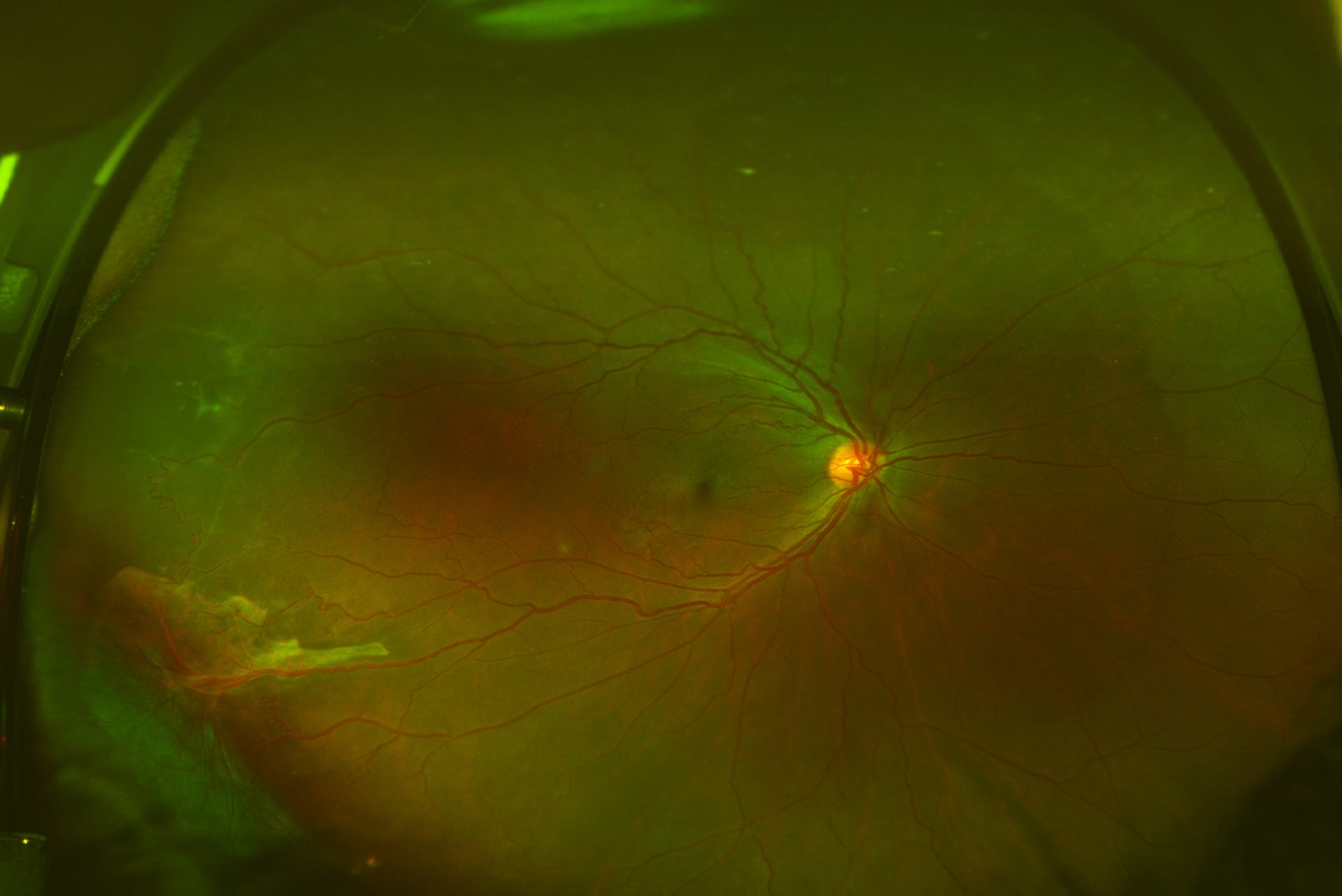 Sickle Cell Retinopathy: clinical photograph, second view