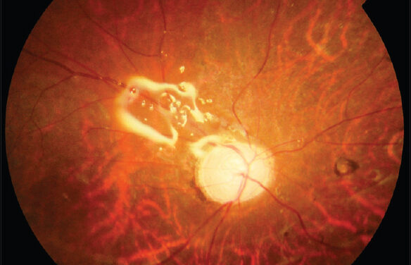 Silicone Oil Tamponade: Complications, Timing of Removal and What to Watch For