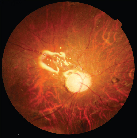Silicone Oil Tamponade: Complications, Timing of Removal and What to Watch For