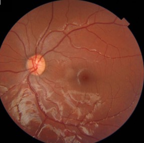 Skew Deviation: The Vertical Misalignment That Isn’t a Palsy