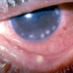Clinical eye photograph illustrating Staphylococcal Marginal Keratitis