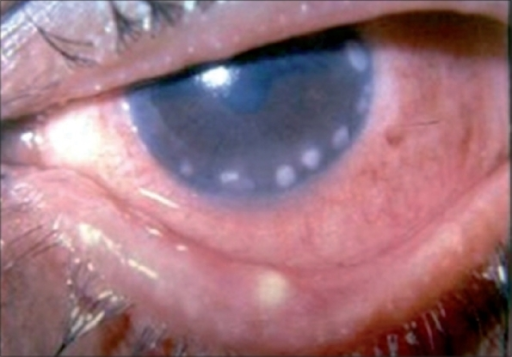 Staphylococcal Marginal Keratitis: An Immune Reaction, Not an Infection