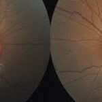 Steroid Induced Glaucoma: clinical photograph