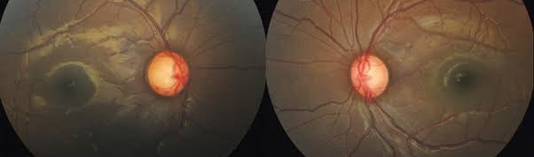 Steroid-Induced Glaucoma: The Pressure Rise Prescribers Forget to Check