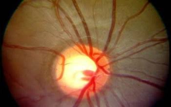 Steroid Induced Glaucoma Clinical Photograph 2 Steroid Induced Glaucoma: clinical photograph, second view