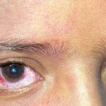 Sturge-Weber syndrome: patient with a periocular port-wine stain and an injected eye on the affected side