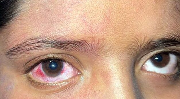 Sturge-Weber Syndrome: Glaucoma, Choroidal Hemangioma and the Surgical Traps