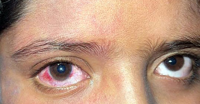 Sturge-Weber Syndrome Periocular Port-Wine Stain Sturge-Weber syndrome: patient with a periocular port-wine stain and an injected eye on the affected side