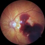 Submacular Hemorrhage Management: clinical photograph