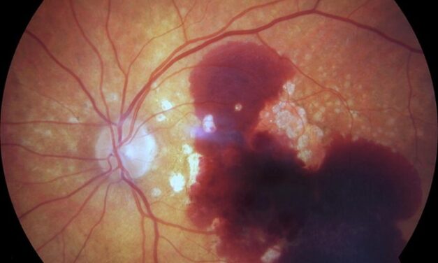 Submacular Hemorrhage: Why This Blood Cannot Just Be Watched