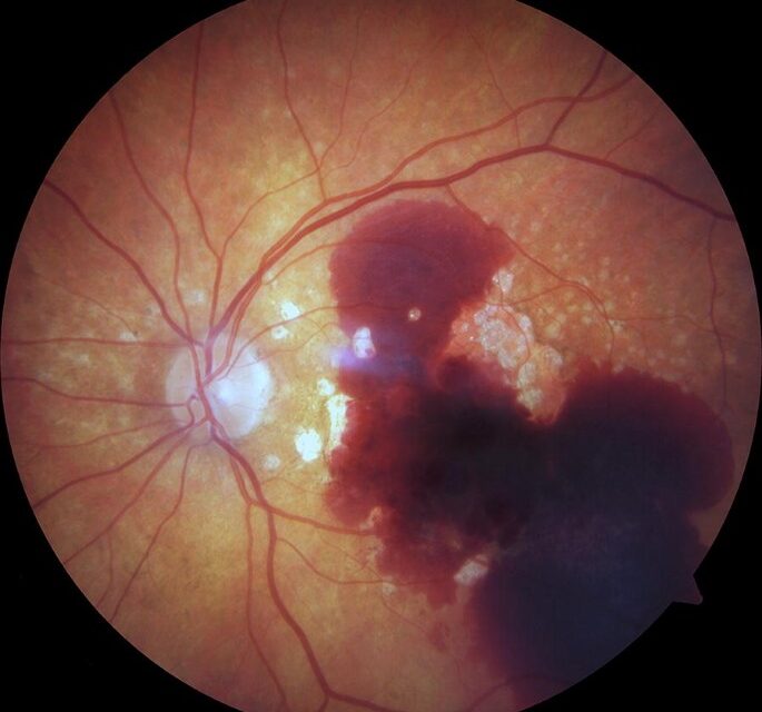 Submacular Hemorrhage: Why This Blood Cannot Just Be Watched