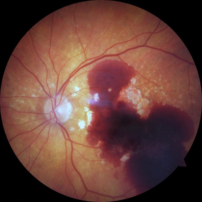 Submacular Hemorrhage Management Clinical Photograph 1 Submacular Hemorrhage Management: clinical photograph