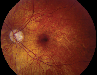 Submacular Hemorrhage Management Clinical Photograph 2 Submacular Hemorrhage Management: clinical photograph, second view