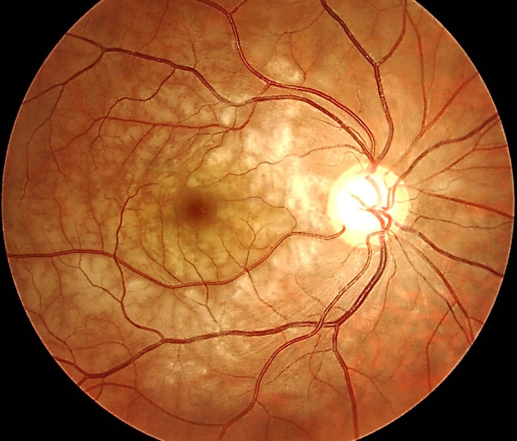 Paracentral Acute Middle Maculopathy