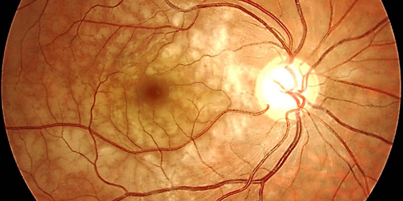 Paracentral Acute Middle Maculopathy: A Diagnosis OCT Made Possible