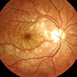 Paracentral Acute Middle Maculopathy