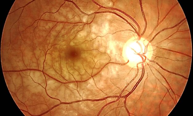 Paracentral Acute Middle Maculopathy: A Diagnosis OCT Made Possible