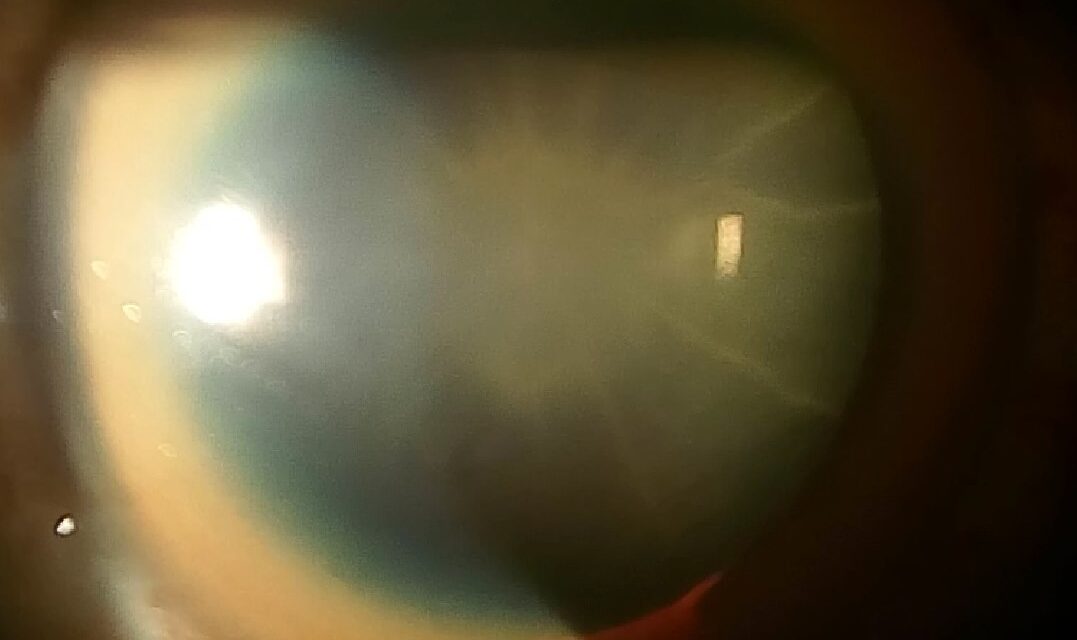 Sunflower Cataract: Wilson’s Disease Beyond the Kayser-Fleischer Ring