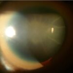 Sunflower cataract: copper deposition in a radiating stellate pattern on the anterior lens capsule in Wilson's disease
