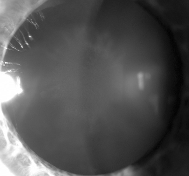 Sunflower cataract: slit-lamp photograph of the lens in a patient with Wilson disease