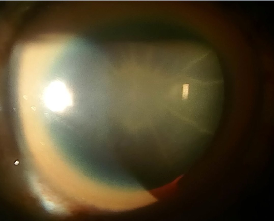 Sunflower cataract: copper deposition in a radiating stellate pattern on the anterior lens capsule in Wilson's disease