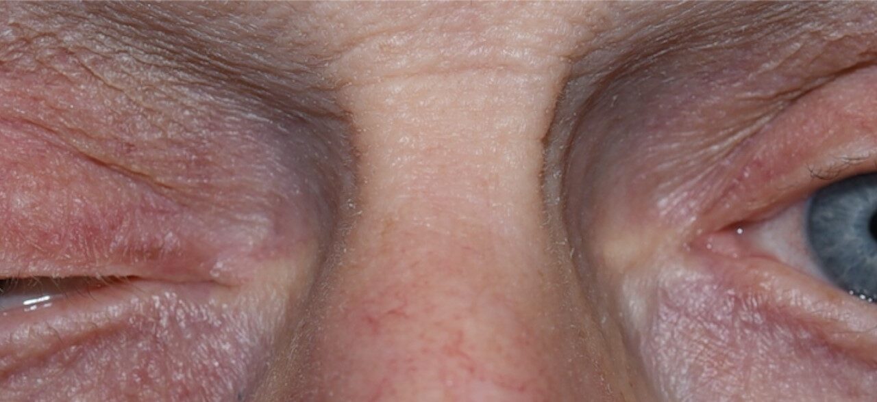 Third Nerve Palsy: Why the Pupil Decides the Urgency