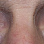 Third Nerve Palsy: clinical photograph