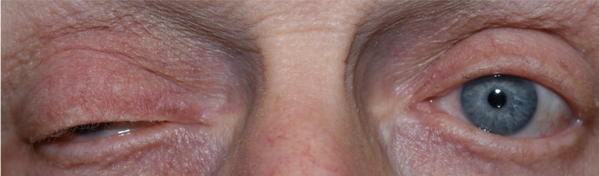 Third Nerve Palsy: clinical photograph