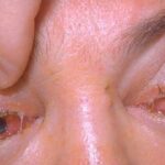 Trichinosis