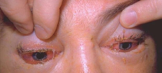 Trichinosis: Periorbital Edema as an Early Warning Sign