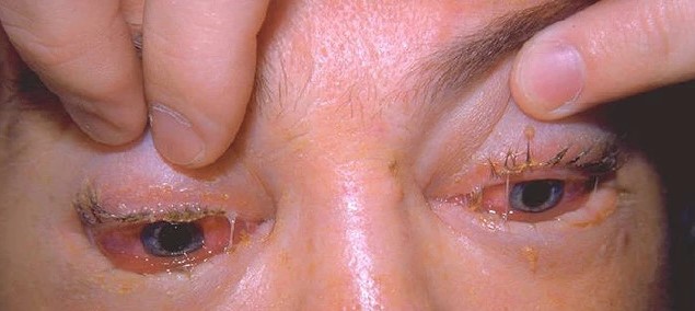 Trichinosis: Periorbital Edema as an Early Warning Sign