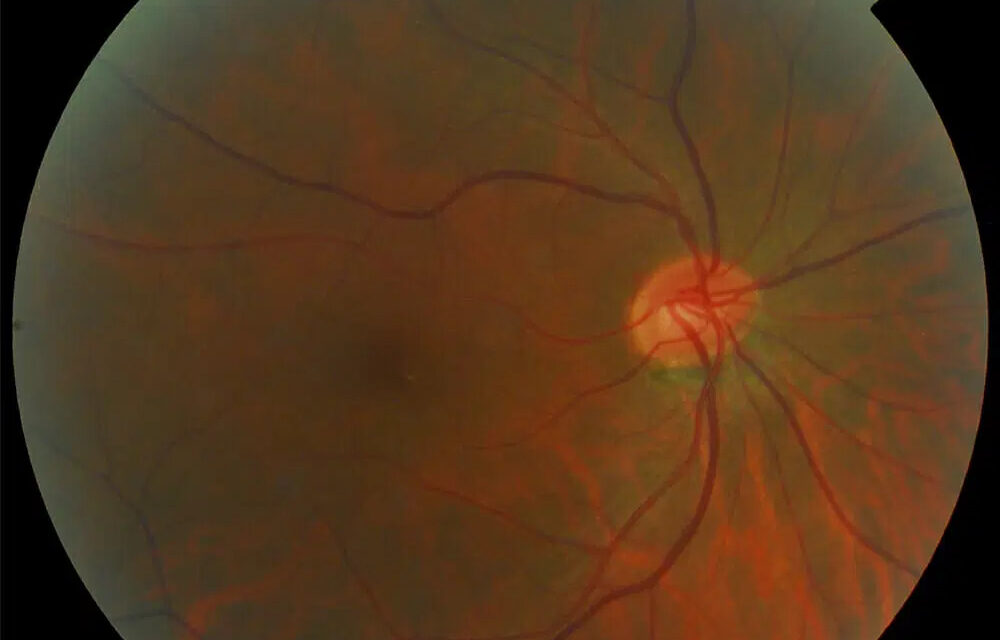 Toxic and Nutritional Optic Neuropathy: A Recognizable, Reversible Pattern