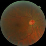 Toxic Nutritional Optic Neuropathy: clinical photograph