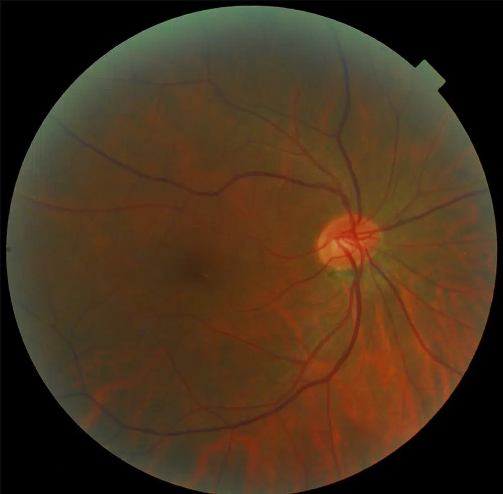 Toxic Nutritional Optic Neuropathy: clinical photograph