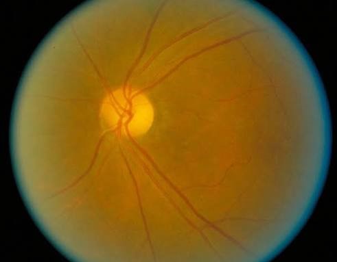 Toxic Nutritional Optic Neuropathy: clinical photograph, second view
