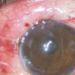 Trabeculectomy: eye after trabeculectomy showing the conjunctival filtering bleb and hyperemic conjunctiva