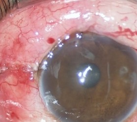 Trabeculectomy: The Benchmark Glaucoma Filtering Surgery