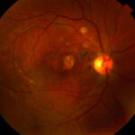 Traumatic macular hole: fundus photograph six months after surgery showing a closed macular hole with pigmentary changes