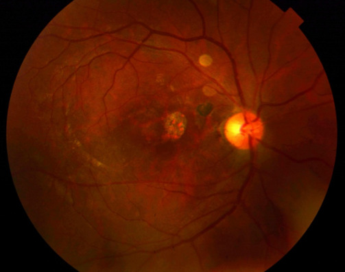 Traumatic Macular Hole: When to Watch and When to Operate